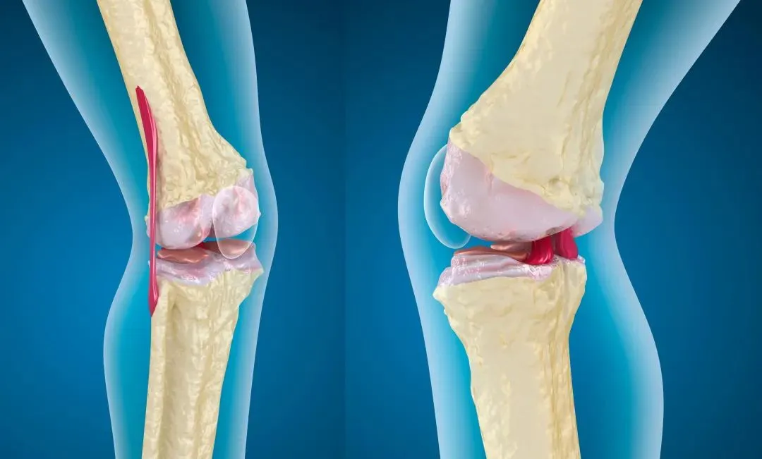 image Illustration comparing a healthy knee joint with one showing cartilage degeneration